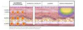 Tighten your facial skin with Ultherapy / 5 Key, Novena