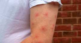 How To Treat and Avoid Mosquito Bites, Spring Hill