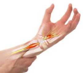 5 Outcomes of Carpal Tunnel Syndrome Treatment , Novena