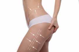 Thigh Lift (Thighplasty) in San francisco Bay Area, San Francisco