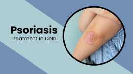 Psoriasis Treatment in Delhi | Mehektagul Dermacli, New Delhi