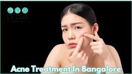 Acne Treatment In Bangalore, Bengaluru