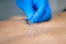 Dry Needling Near Penn Station | Dr. Grover Wellne, New York