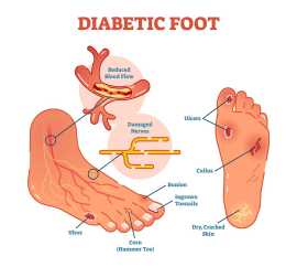 Advanced Diabetic Wound Care Brooklyn - Dr. Oleg K, Brooklyn