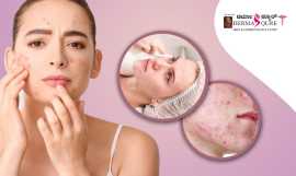 Top Acne Treatment in Bangalore at Dermaqure, Bengaluru