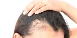 FUE Hair Transplant in Mumbai, Mumbai