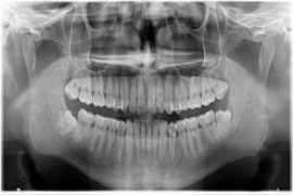 Recommended by Top Dentists – Get Your OPG Scan !, Mumbai