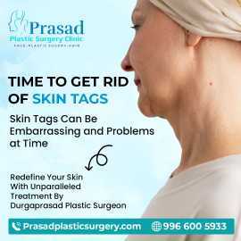 Skin Tag Removal Treatment in Visakhapatnam, Visakhapatnam