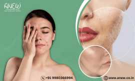 Acne Scar Removal Treatment in Bangalore at Anew, Bengaluru