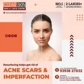 best vbeam laser treatment in india, Kurnool