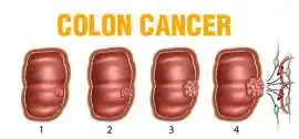 Age and Colon Cancer Symptoms, Bukit Timah