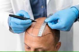 Types Of Hair Transplant Procedures , Kolkata