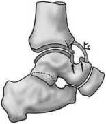 6 Options of Cartilage Repair Surgery, Novena