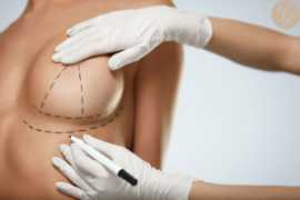 Breast Lift in Newport Beach, Newport Beach