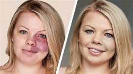 Birthmark Treatment in Jaipur, Jaipur