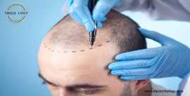 Hair Transplant Doctor in Delhi, New Delhi