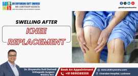 Swelling After Knee Replacement | Dr. Divyanshu, Lucknow