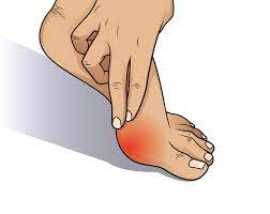 5 Bunion Surgery Types , Novena