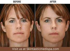 Skin Brighten with IPL Treatment , Riverside