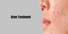 Acne Scar Treatment in Bangalore, Bengaluru