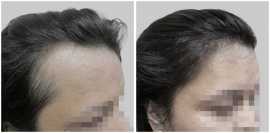 Rediscover Your Confidence: Transformative Hair Tr, Delhi