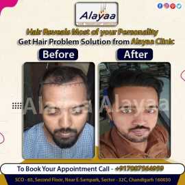 DHI Hair Transplant clinic in chandigarh METHOD SU, Chandigarh