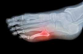 6 Remedies for carpal tunnel syndrome treatment, Novena