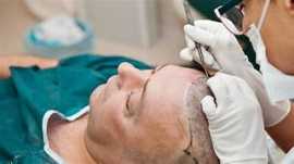 Hair Transplantation Cost in Rajasthan, Jaipur