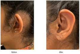 Ear Surgery in San Francisco, San Francisco