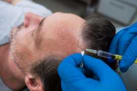 Hair Transplant Surgery Brisbane, Brisbane