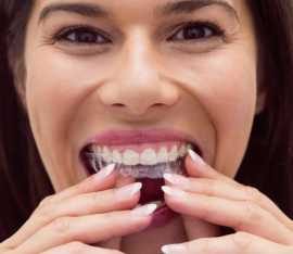Solutions for Invisible Braces in Ahmedabad, Ahmedabad