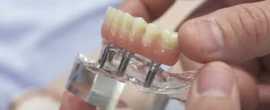 Dental Implants in Koregaon Park, Pune, Pune
