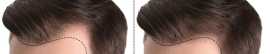 Hair Transplant in Mumbai, Mumbai