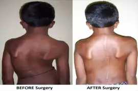 Spine Surgery In India, Bengaluru
