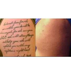 Laser Tattoo Removal in Mississauga, Mississauga