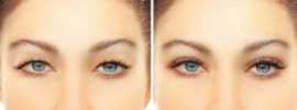 Upper Eyelid Lift Surgery, San Francisco