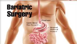 San Francisco Bariatric Surgery Procedures , San Francisco
