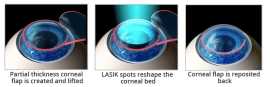 Laser Precision Meets Vision Correction Through LA, Melbourne