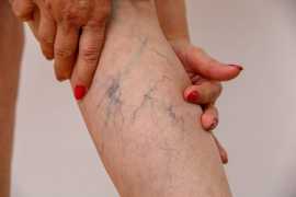 What is a Varicose Vein Specialist Called?, Lindenhurst