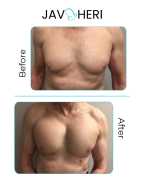 Chest Implants for Men Guys: A Path to Enhanced Ma, San Francisco