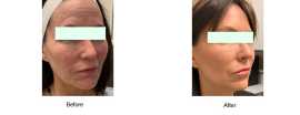 How Long Does Recovery Take After a Thread Lift fo, San Francisco