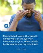 Is Pterygium Affecting Your Vision? Learn About , Brisbane