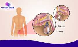 Varicocele Treatment in Bangalore at Orchid Health, Bengaluru
