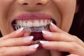 Get Straighter Teeth with Invisalign in Sydney!, Sydney
