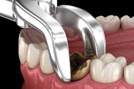 Expert Care for Painless Tooth Extractions, Delhi