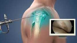 Get Your Shoulder Pain Free by Arthroscopy, New Delhi