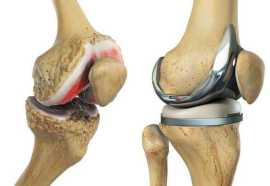 Best Knee Replacement Surgeon in Mansarovar, Jaipur
