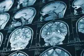 Santa Monica Brain Injury Lawyer for Severe Cases, Santa Monica