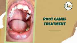 Root Canal Treatment at the Best Dental Hospital i, Bengaluru