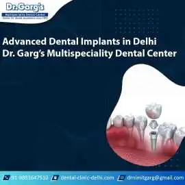 Advanced Dental Implants in Delhi | Dr. Garg’s Mul, Delhi